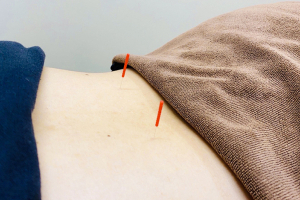 カラダのミカタ　井高野院の鍼灸施術の施術風景画像です。