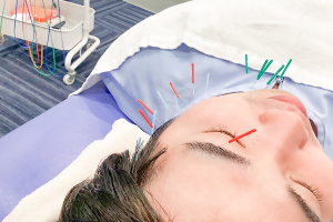 スポーツ総合治療院ＡＣＴ学芸大学店の美容鍼の施術画像