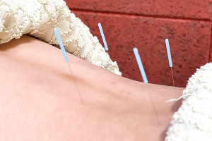 六本木ミッドタウン前整骨院・鍼灸院の鍼灸施術の施術風景画像です。