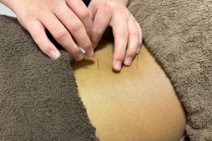 まいれ鍼灸整骨院・整体院　草津院の鍼の施術風景画像です。