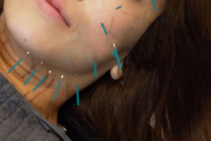 亀田整骨院の美容鍼の施術風景画像です。