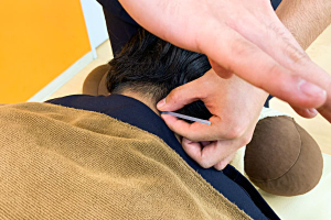 下井草駅前接骨院の鍼灸の施術画像