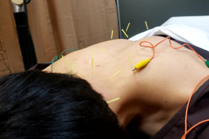 ＡＲＡＫＩ鍼灸院／整骨院　緑橋駅前店の鍼灸施術の画像