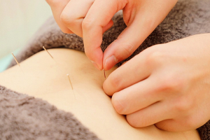 野本鍼灸整骨院　戸越院の鍼灸施術の画像です。