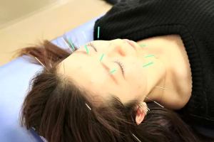 小林整骨院鍼灸院掛川の鍼灸の施術画像