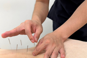 平成接骨院・鍼灸マッサージ院の鍼灸の施術画像