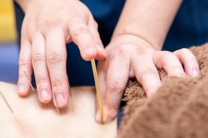 ぐみょうじ鍼灸整骨院　かんのん通り院の鍼灸の施術画像