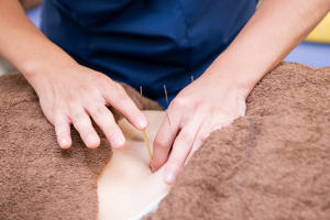 すぎた鍼灸整骨院　ぷらむろーど商店街院の鍼灸施術の施術風景画像です。