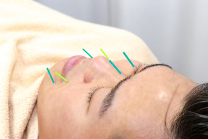 宇都宮宿郷鍼灸整骨院の鍼灸施術の施術風景画像です。