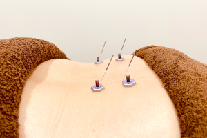 ふかた整骨院の鍼灸施術の施術風景画像です。