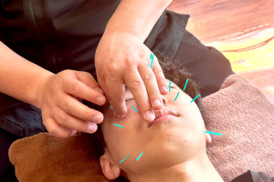 くまのみ整骨院　池袋東口院の美容鍼の施術風景画像です。