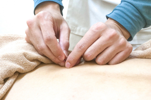 もみいはりきゅう整骨院の鍼灸施術の画像