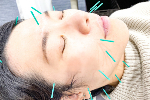 文の里駅前整骨院　阿倍野区院の美容鍼の施術画像