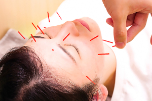 ＮＯＭＯＫＯＴＳＵ鍼灸整骨院　松原商店街院の鍼灸施術の施術風景画像です。