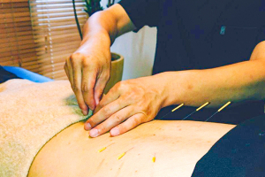 鍼灸・マッサージハリケア　千歳烏山駅院の鍼灸の施術画像