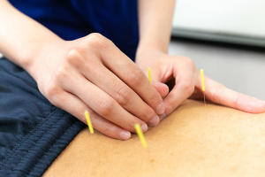 大宮駅前鍼灸接骨院の鍼灸施術の画像