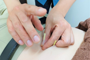 エルフィン北広整骨院の鍼施術風景画像です。