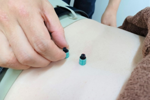 エルフィン北広整骨院の灸施術風景画像です。