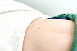 さくら鍼灸・接骨院　屏風浦院の鍼灸施術の施術風景画像です。