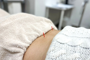 さくら鍼灸・接骨院　金沢八景駅前院の鍼灸施術の施術風景画像です。