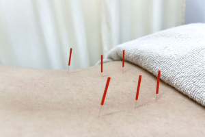 さくら鍼灸・接骨院　希望ヶ丘院の鍼灸施術の施術風景画像です。