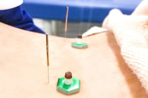 長津田北口接骨院（旧：にじいろ鍼灸整骨院　長津田院）の鍼灸施術の施術風景画像です。