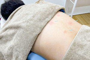 七つ葉鍼灸接骨院東静岡柚木駅前院の鍼灸施術の画像