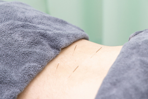 ＮＯＭＯＫＯＴＳＵ鍼灸整骨院　よこはまばし院の鍼灸施術の施術風景画像です。