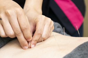 ＮＯＭＯＫＯＴＳＵ鍼灸整骨院　塚本西口院の鍼灸施術の施術風景画像です。