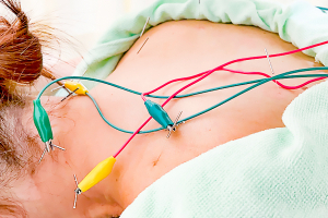 えがおウェルネス整骨院の鍼灸施術の施術風景画像です。