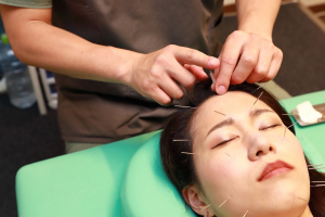 ハリライフ大森鍼灸整骨院の美容鍼の施術画像