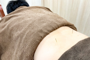 古河上辺見鍼灸接骨院の鍼灸施術の施術風景画像です。