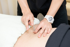 溝口あおば接骨院はりきゅう院の鍼灸の施術風景画像です。