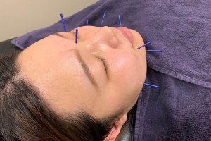 西浦和駅前鍼灸接骨院の美容鍼施術の施術風景画像です。