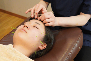 くまのみ整骨院　武蔵浦和駅前院【鍼灸】の美容鍼の施術画像