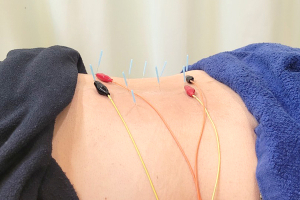 片瀬あおば接骨院の鍼灸施術の施術風景画像です。