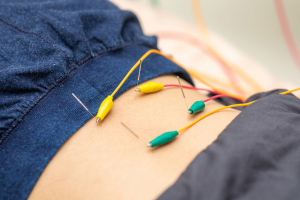 あおば鍼灸院接骨院　栄ナディアパーク店の鍼灸施術の施術風景画像です。