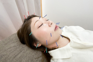 高座渋谷駅鍼灸院・整骨院の美容鍼施術の施術風景画像です。