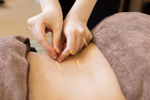 カラダのミカタ鍼灸整骨院　天王寺院の鍼灸施術の施術風景画像です。
