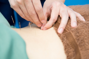 マーサ鍼灸整骨院　イオンタウン浜松新橋院の鍼灸の施術画像