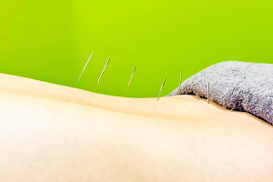 甲斐整骨院　鹿児島院【鍼灸】の鍼灸の施術画像