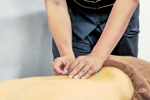 くまのみ整骨院　蕨川口芝院の鍼灸の施術画像