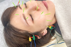 池袋東鍼灸整骨院の美容鍼の施術画像