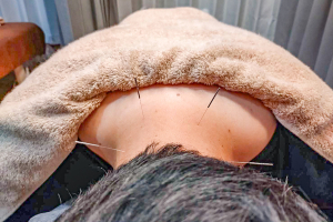 スナグル整骨院鶴見院の鍼施術画像