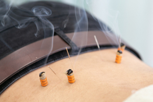 すずらん鍼灸接骨院　荏原中延院の鍼灸施術の施術風景画像です。