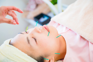 よもぎ鍼灸サロン堺筋本町の美容鍼施術画像