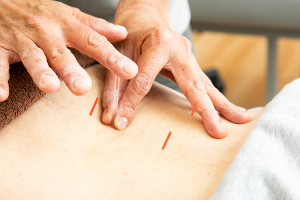 あい鍼灸院・接骨院川西能勢口駅院の鍼施術風景