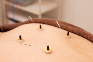 下川接骨院はりきゅうマッサージ院坂戸院の灸施術画像