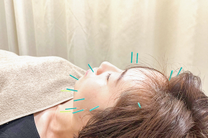鶴ヶ峰鍼灸接骨院の美容鍼施術画像