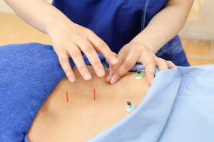 ＶＩＶＡ鍼灸接骨整体院　高柳院の鍼灸施術の施術風景画像です。